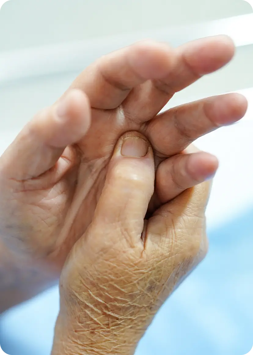 Thumb Joint Osteoarthritis