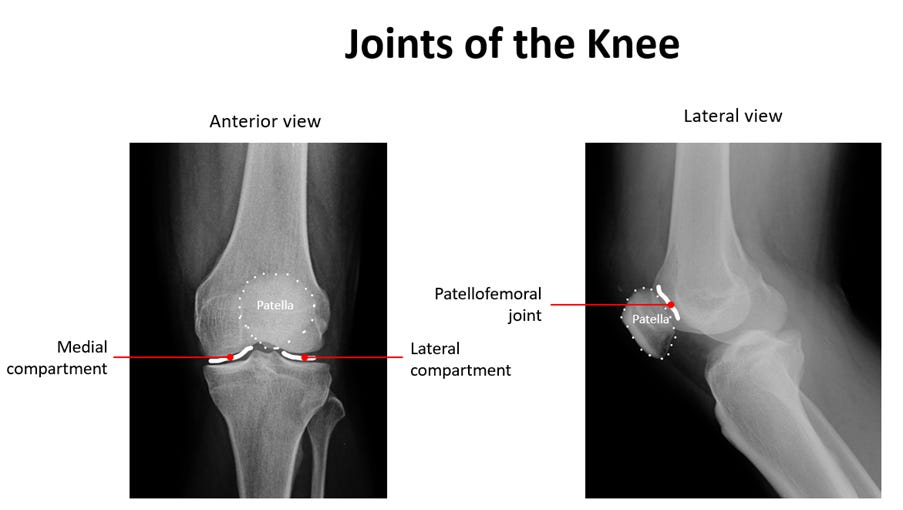 Low-Dose Radiotherapy for Knee Osteoarthritis