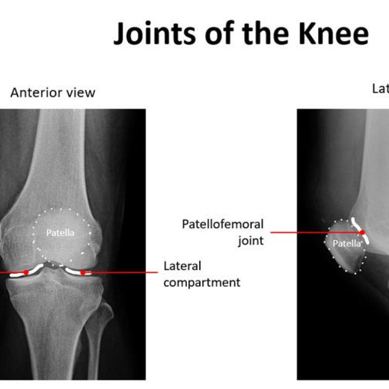 Low-Dose Radiotherapy for Knee Osteoarthritis
